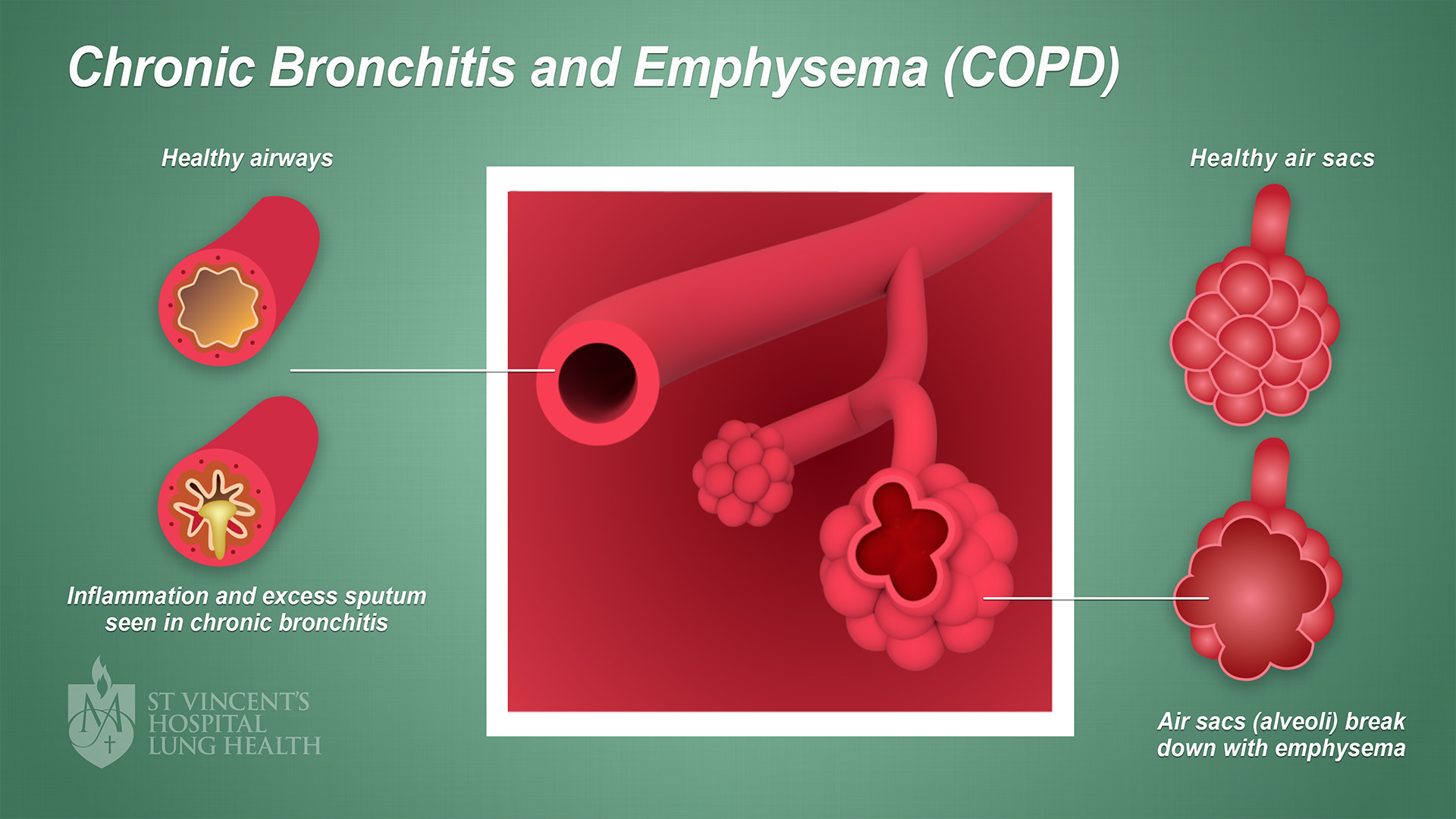 lung cancer biopsy results how long