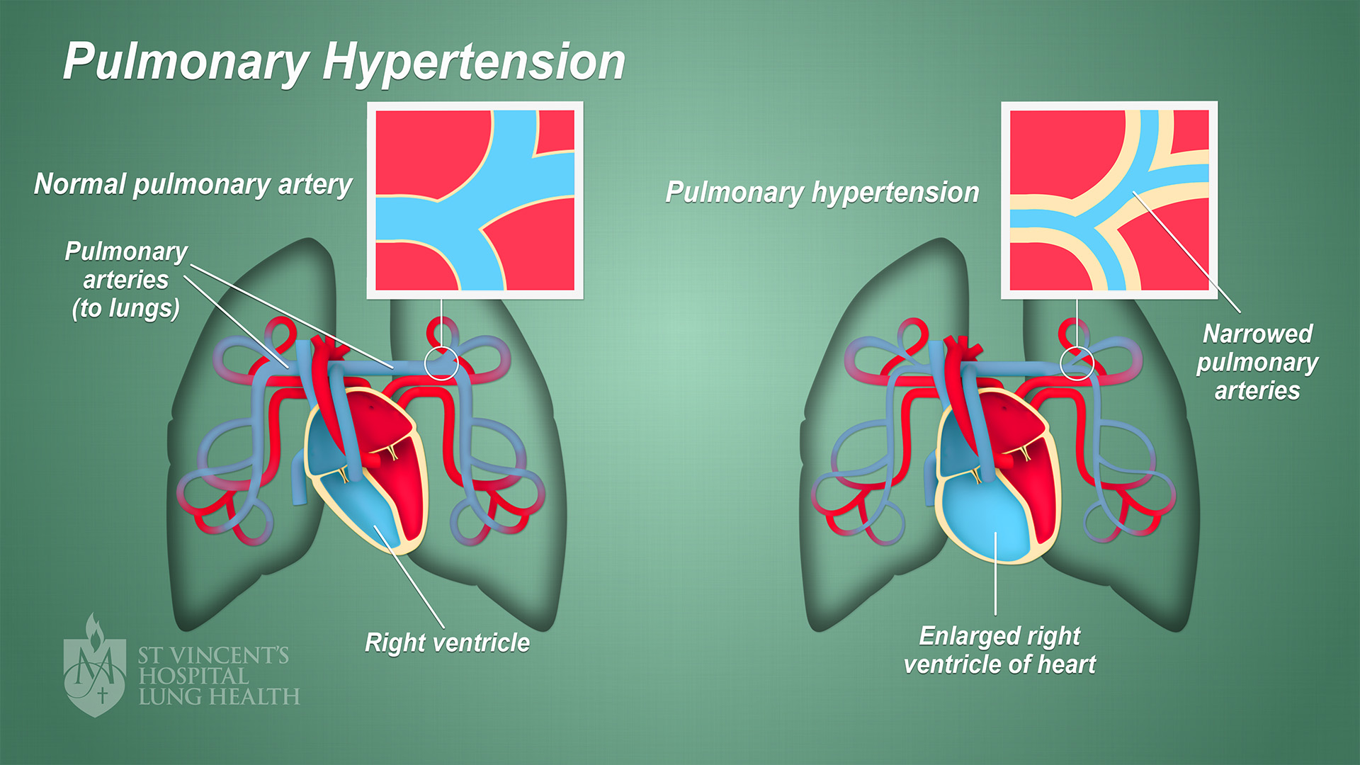 Pulmonary Hypertension St Vincents Lung Health