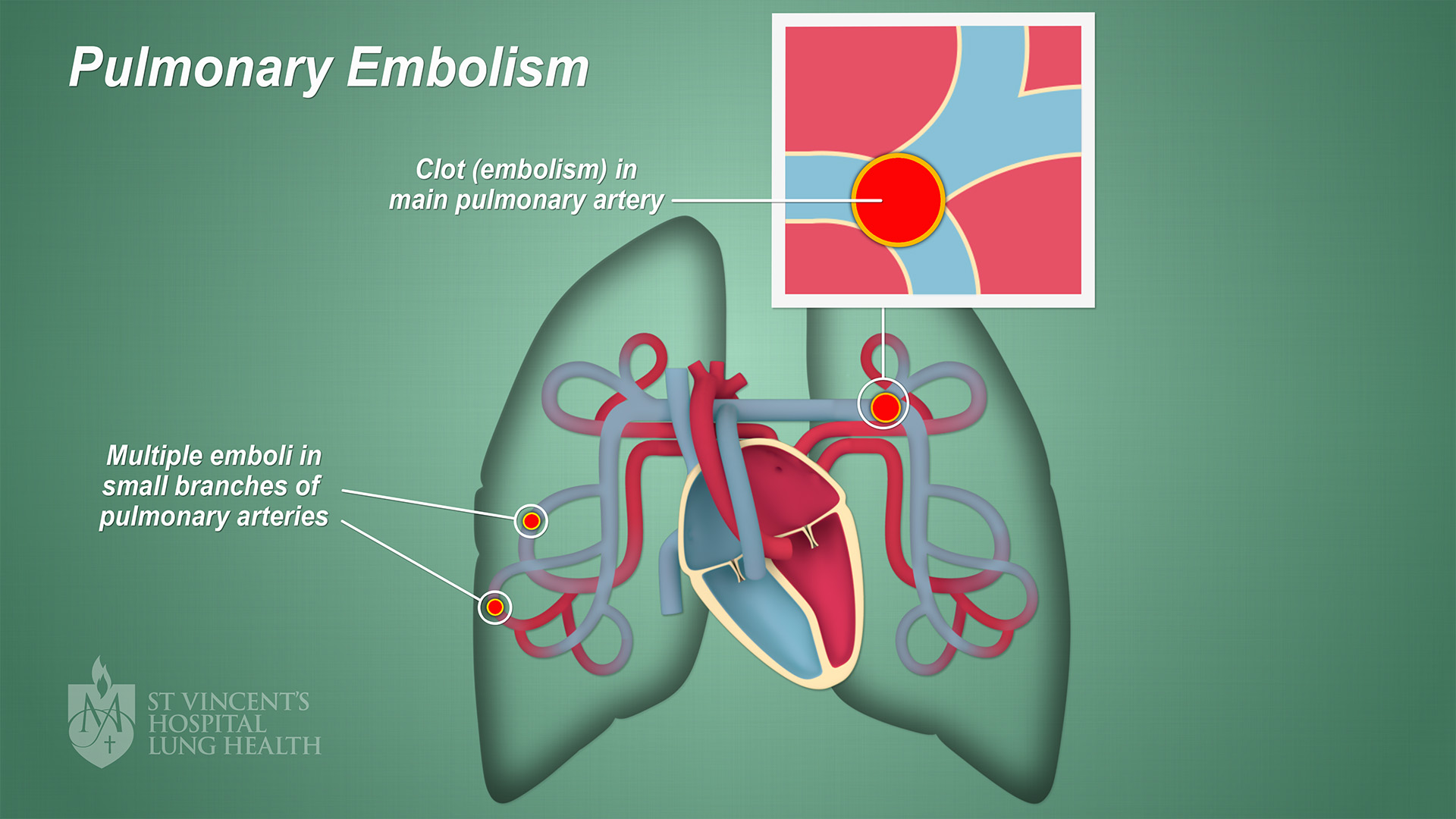 what is the clinical presentation of a pulmonary embolism