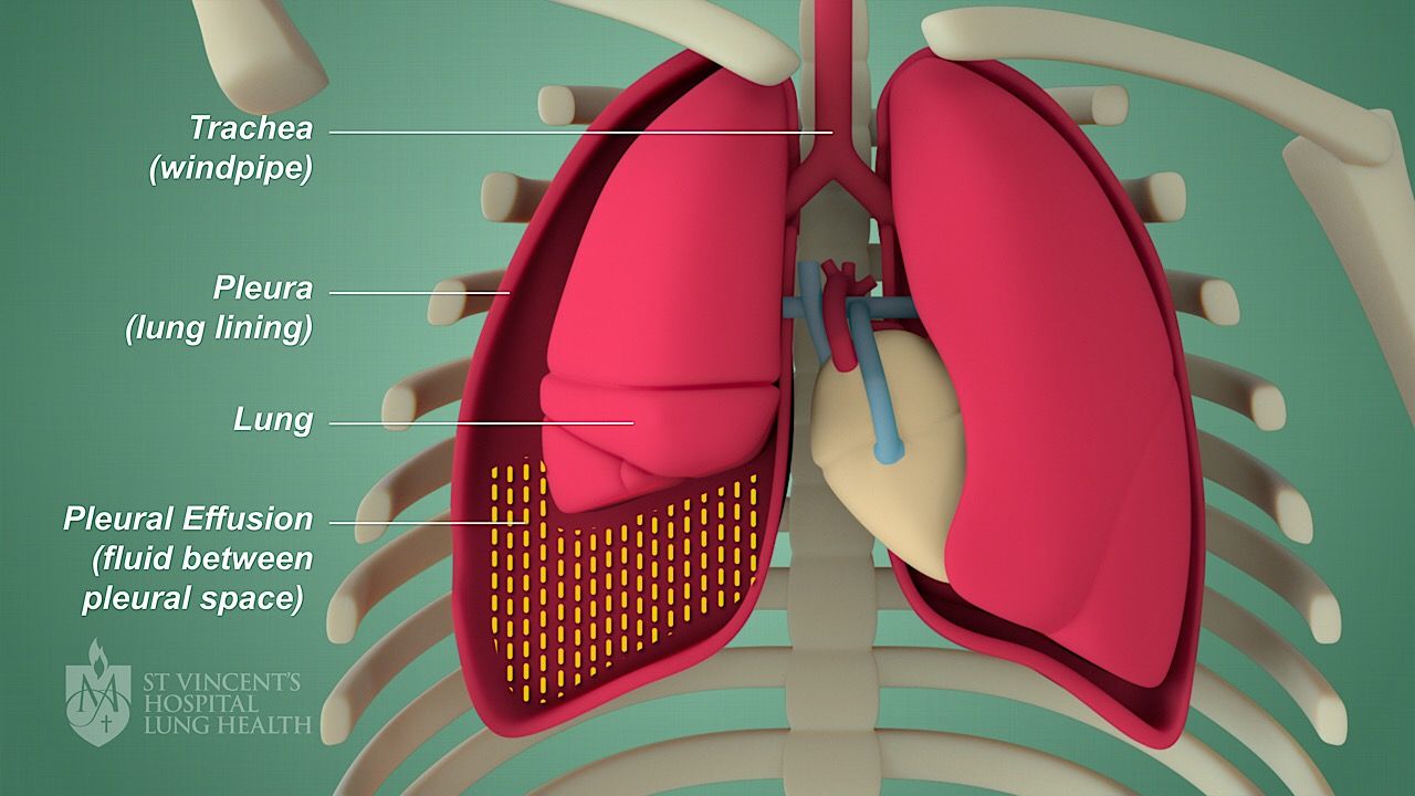 chemotherapy in mesothelioma