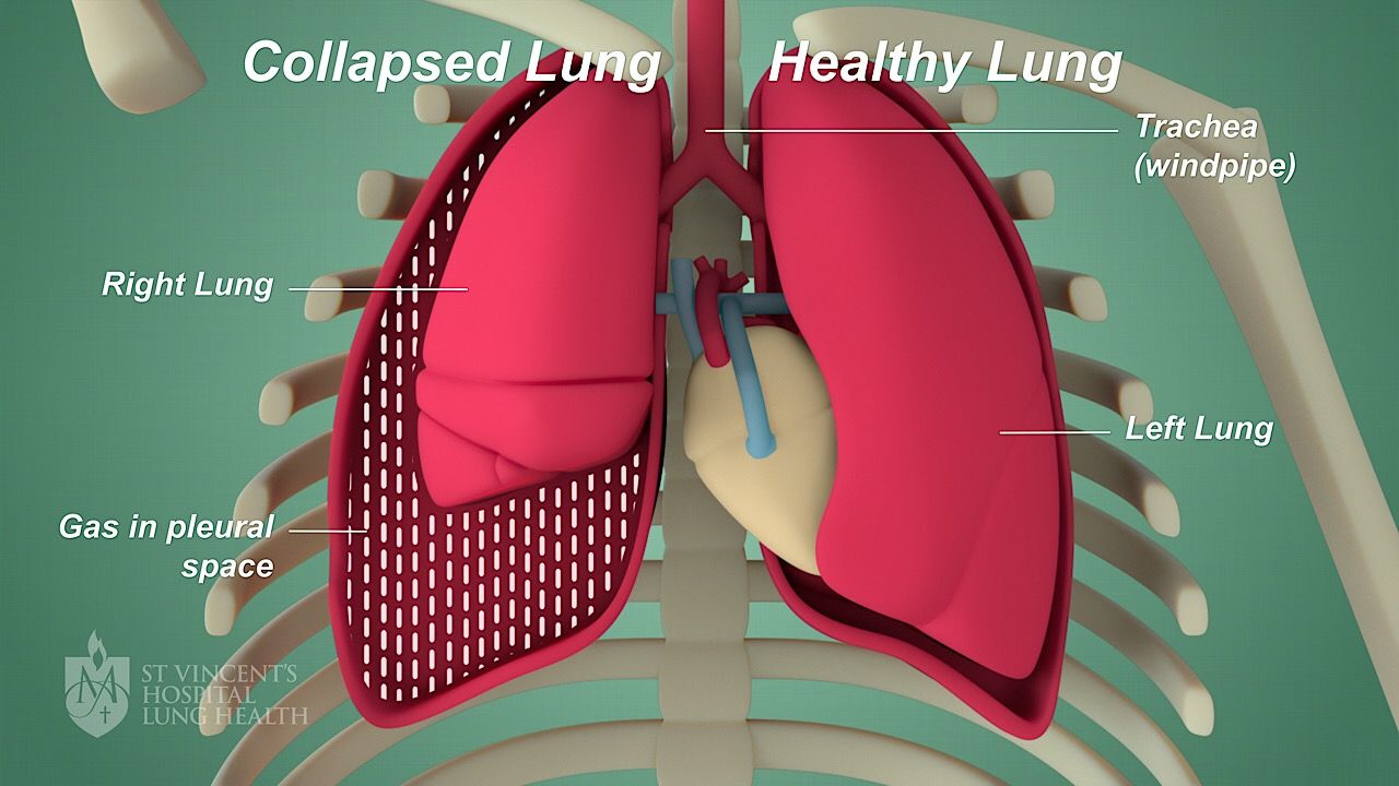 Pneumothorax - St Vincent's Lung Health