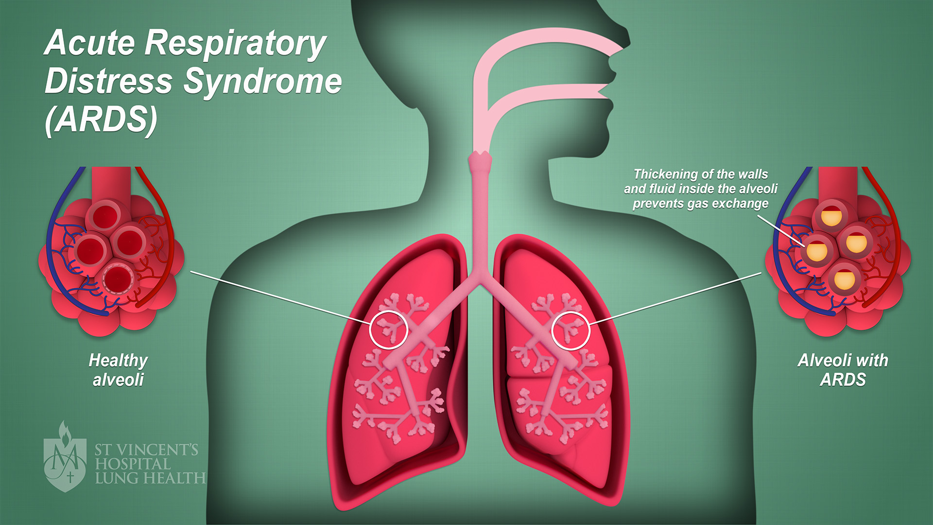 Image result for Acute Respiratory Distress Syndrome - ARDS