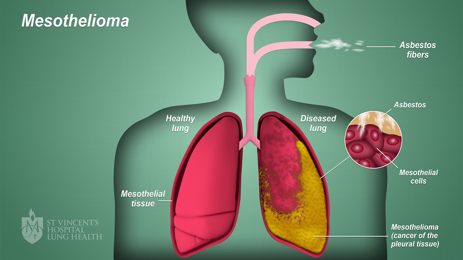 50+ Will asbestos cause copd